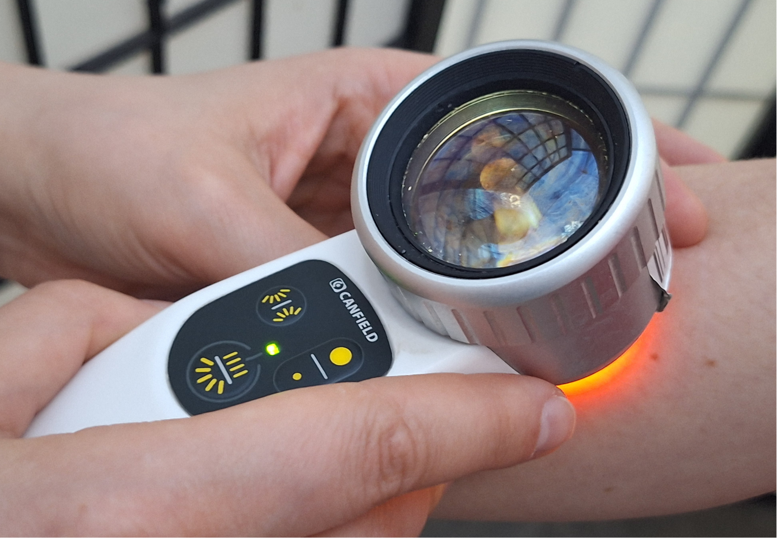 Strach z melanomu přivedl na bezplatné vyšetření téměř 1800 lidí